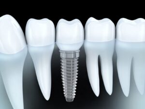 Full Mouth Implants in Plainfield
