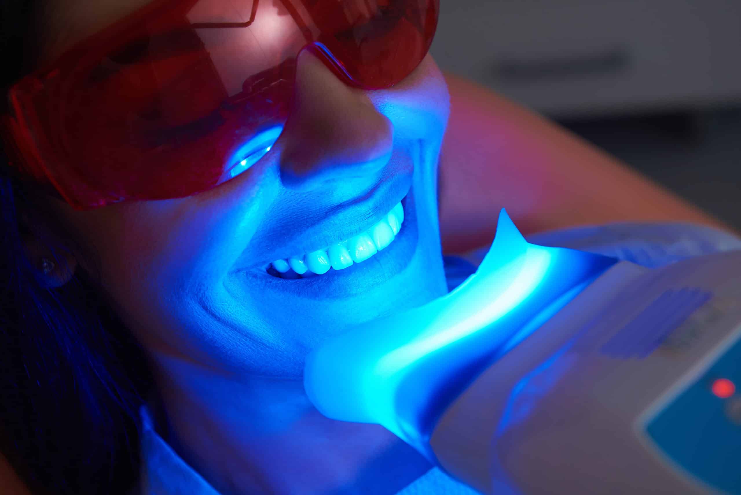 Professional vs At-Home Teeth Whitening: What to Choose