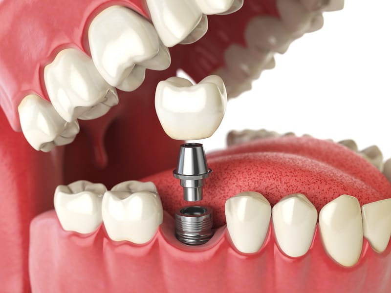 Navigating Dental Implants: Find Your Perfect Smile