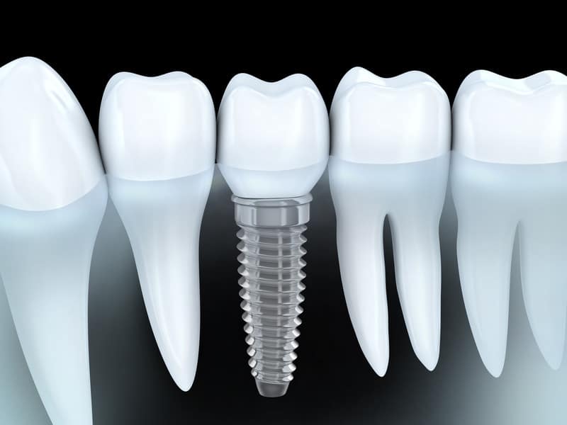 Can Dental Implants Get Cavities? The Surprising Truth
