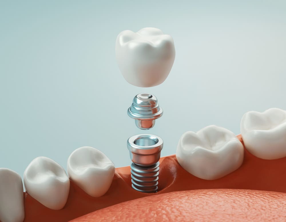 Dental Implants: Your Path to a Restored Smile